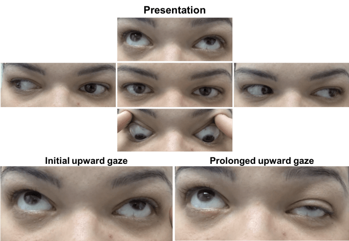 Hesi case study myasthenia gravis